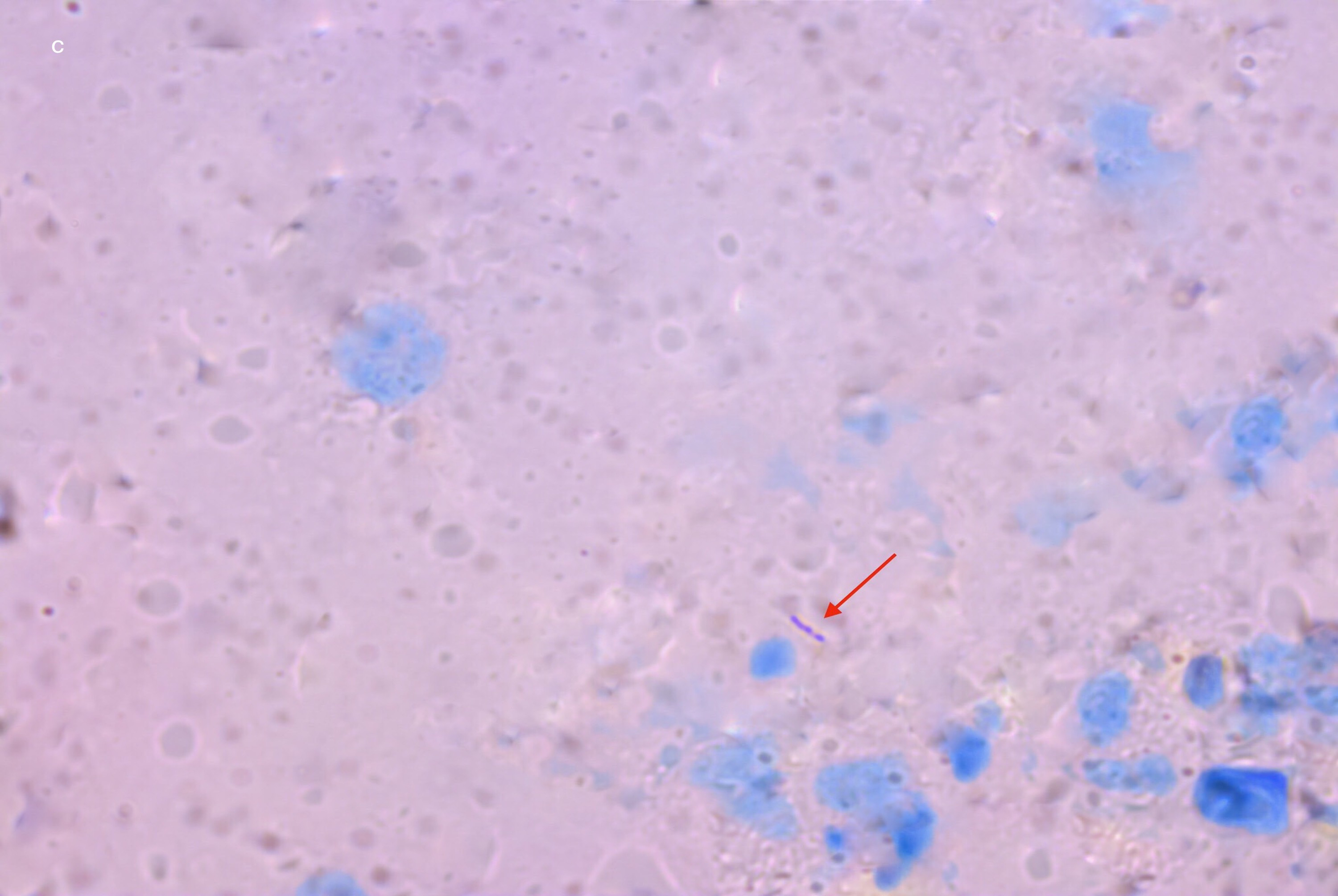 Acid-fast Bacilli in aspirated material from leg nodule (red arrow). (1000×, Ziehl Neelsen stain)