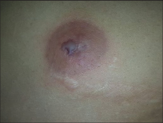 Infiltrated purple plaque around the appendicectomy surgical incision wound