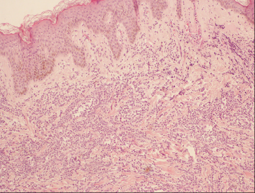 Massive infiltration of haematopoietic cells within the granulocytic sarcoma (H&E, 100x)