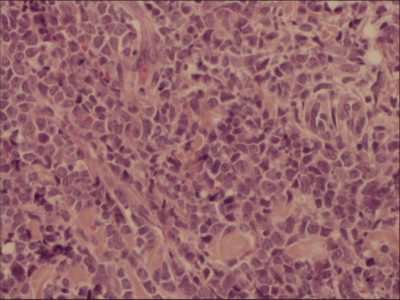 Tumour cells have a high nucleocytoplasmic ratio, with large irregular nuclei, often nucleolated (H&E, 400x)