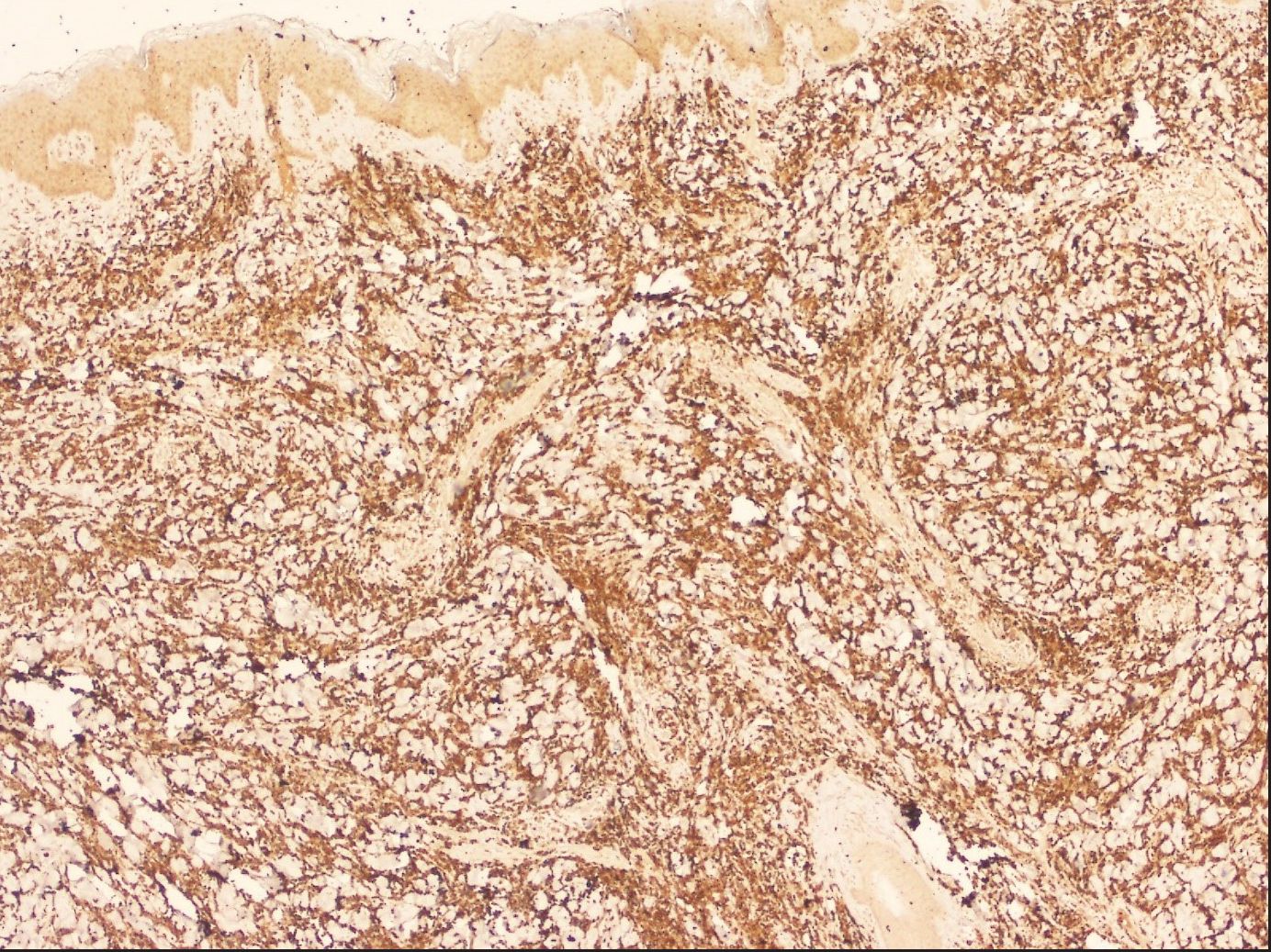 Immunohistochemical analysis shows positivity of blast cells to myeloperoxidase (original magnification, 100x)