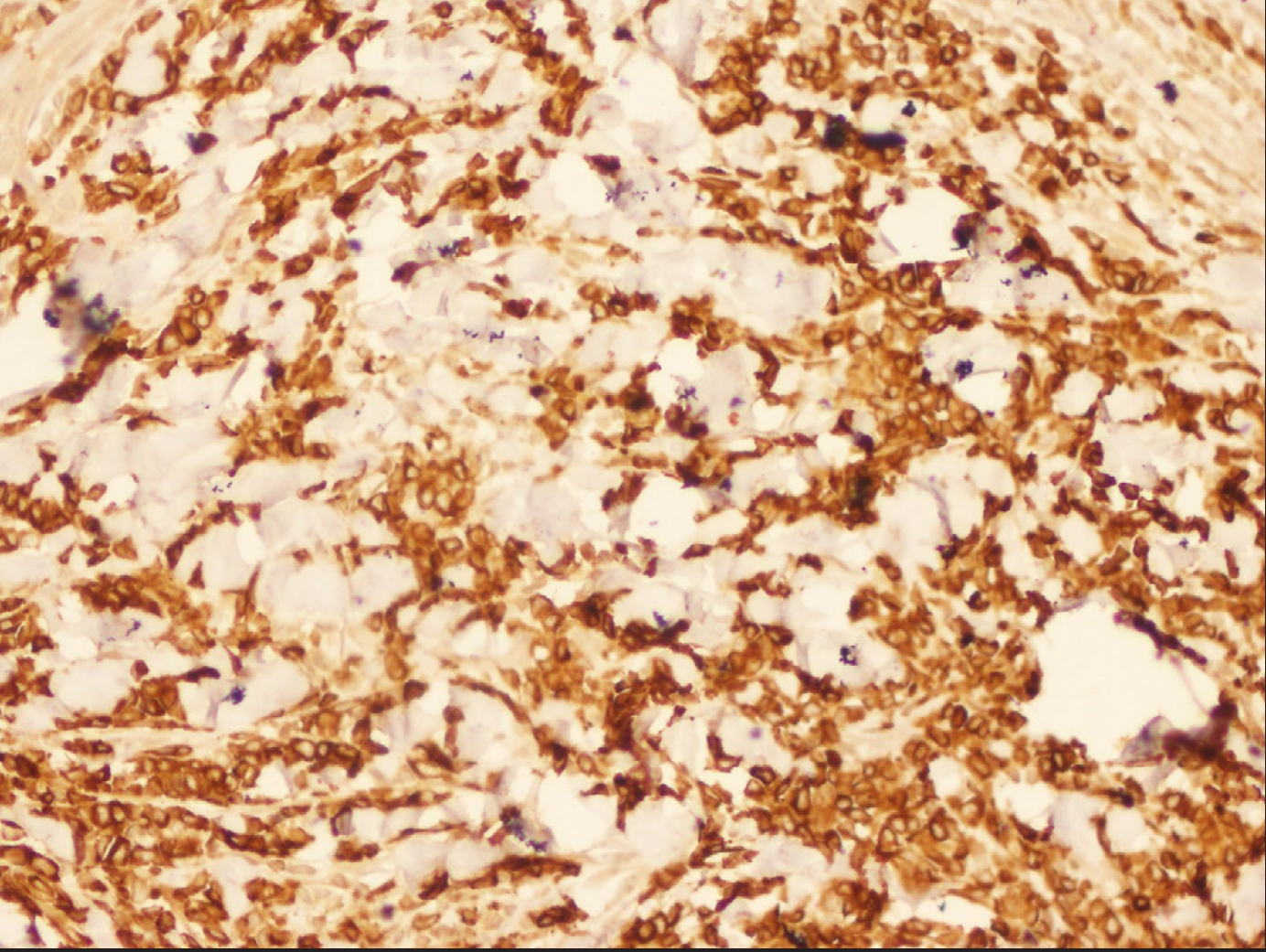 Immunohistochemical analysis shows positivity of blast cells to CD117