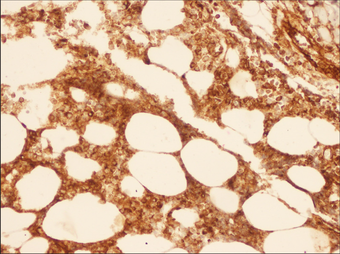 Immunohistochemical analysis shows positivity of blast cells to CD34 (original magnification, 400x)