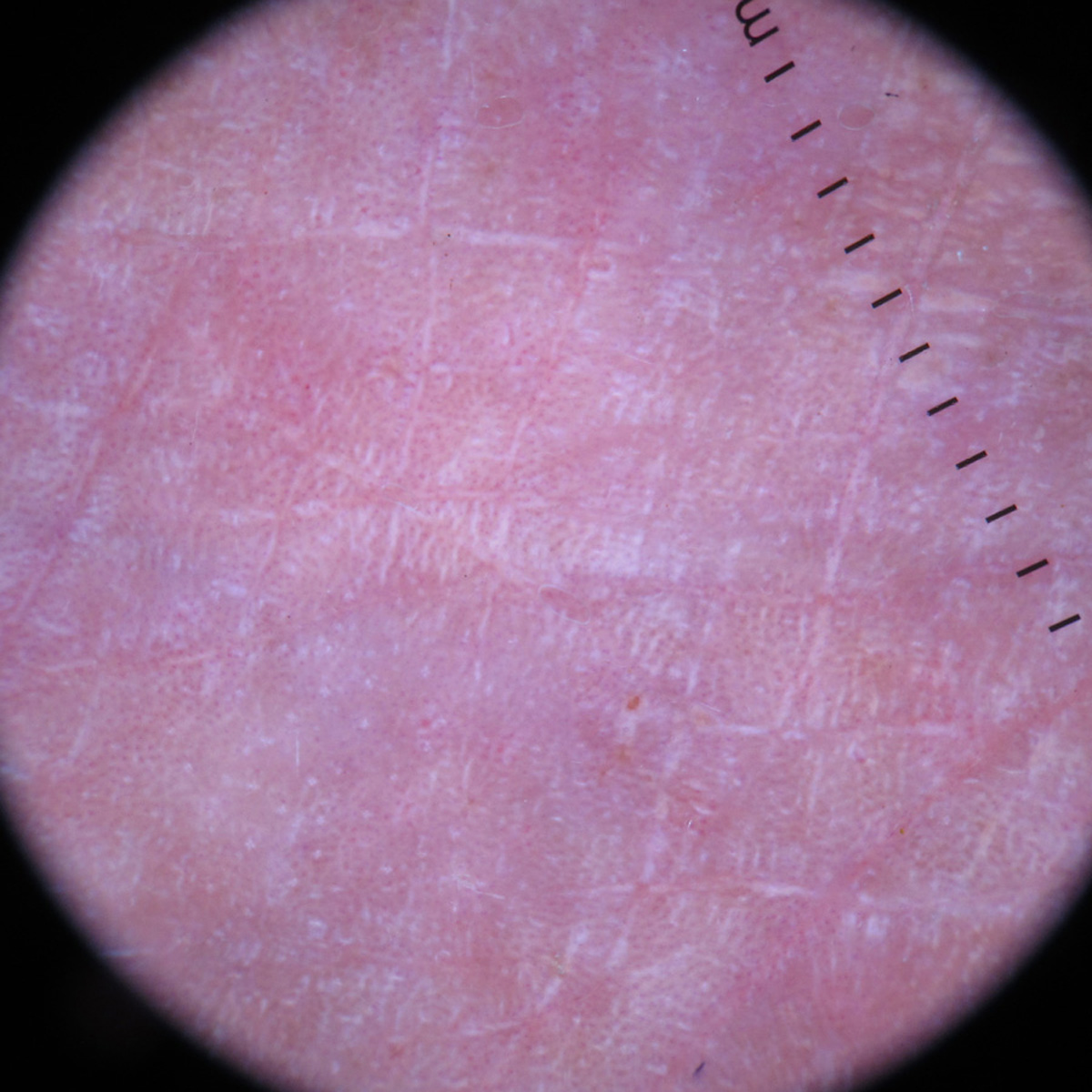 Dermoscopy under polarised mode (Dermlite, DL4, ×10 magnification) shows homogenous pink-white areas, diffuse dotted vessels, and shiny white lines