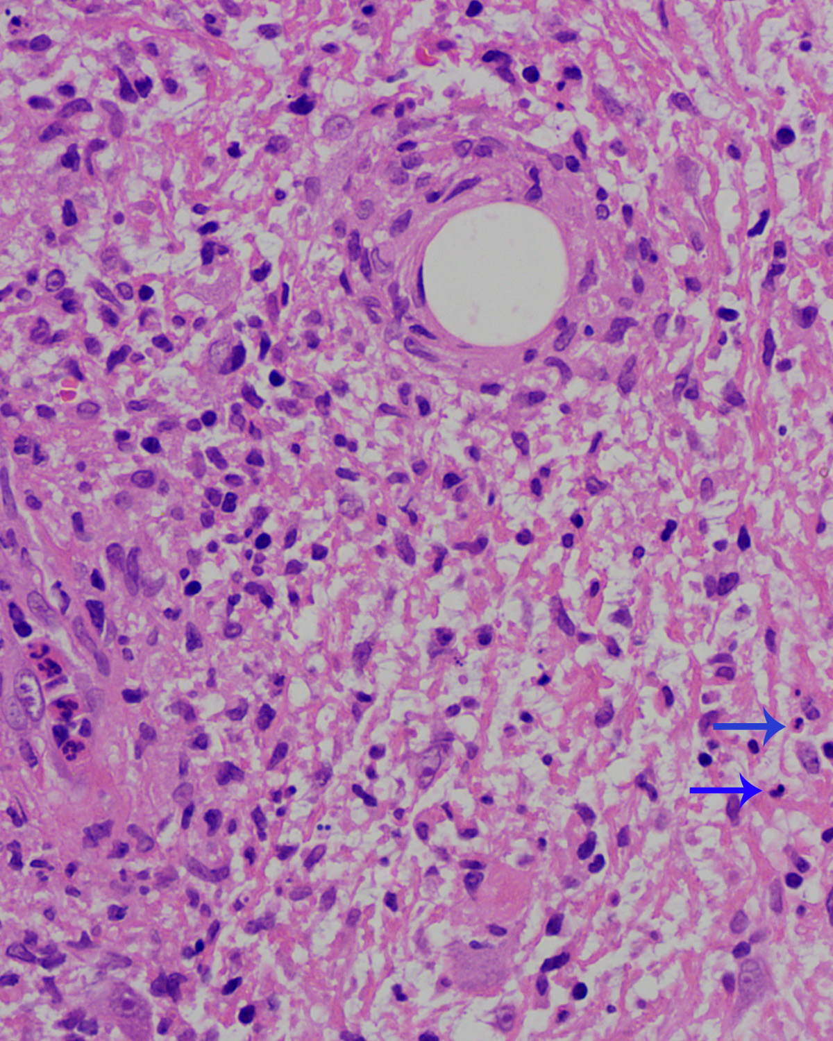 Neutrophilic (arrow) leukocytoclastic vasculitis and leukocytoclasia (H and E, ×400)