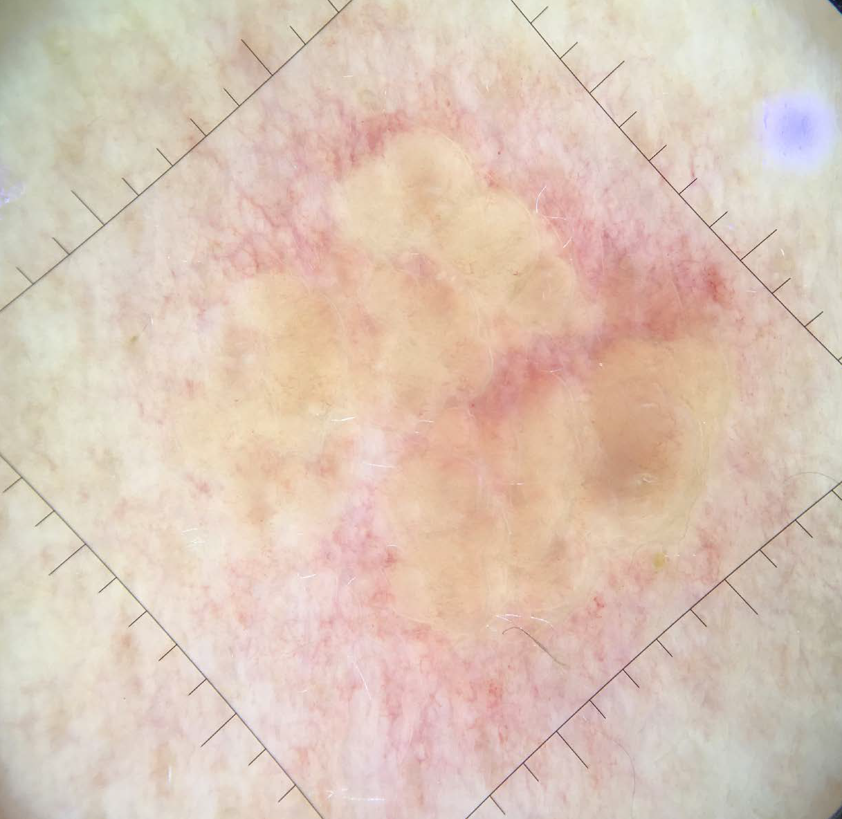 Yellow discoloration evident on applying contact dermoscopy(Image taken with Handyscope®, Fotofinder) ×10