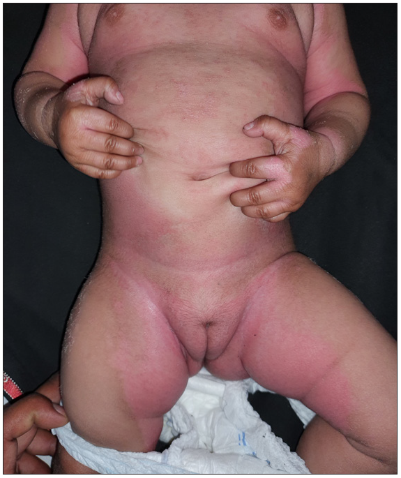 Erythema and scaling involving more than 80% body surface area. The scaling is more prominent in flexures