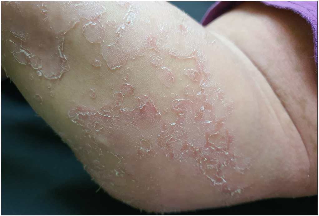 Clinical image shows classical icthyosis linearis circumflexa with double-edged scales