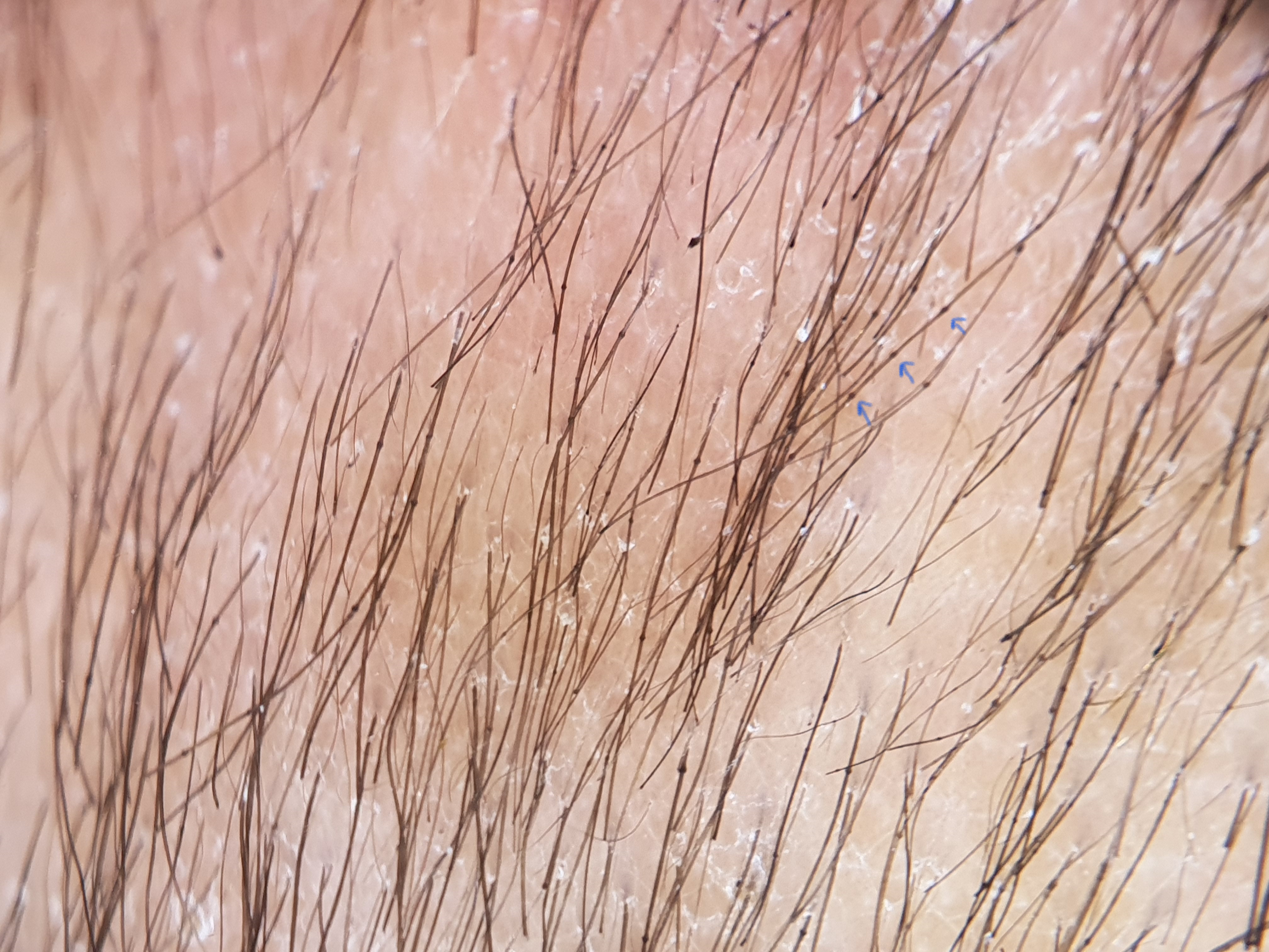 Trichoscopy shows white scales, nodes on the hair shaft (blue arrow) and broken hairs (polarised dermoscopy, Dermlite DL4 ×10)