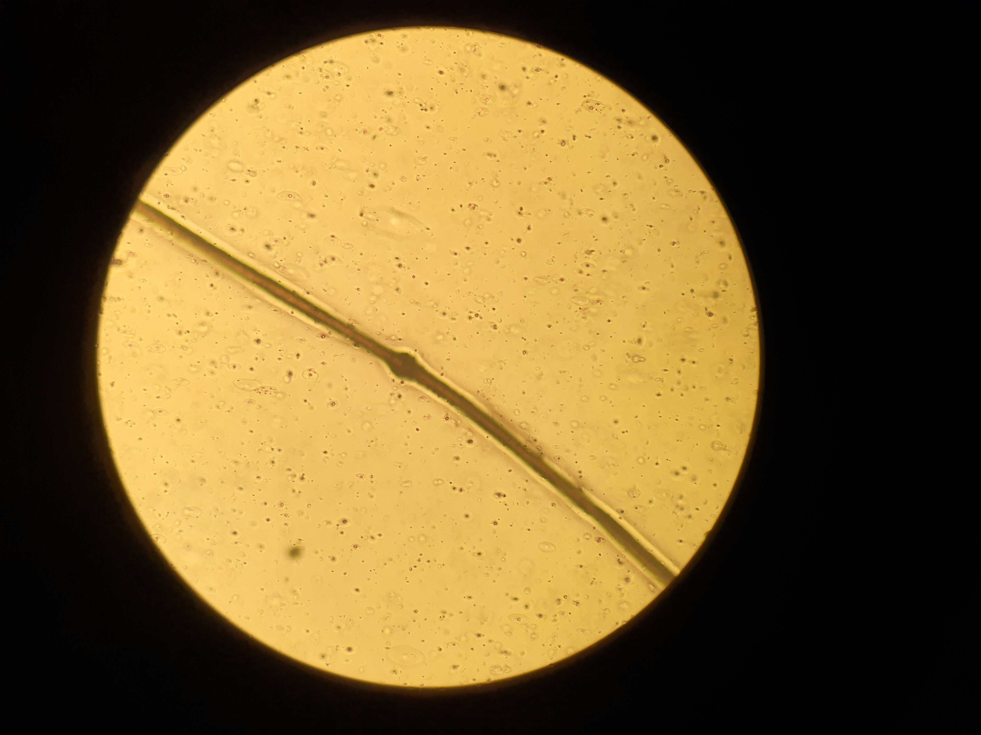 Hair microscopy shows node on the hair shaft (dry mount, ×400)