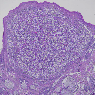 Dermal nodular proliferation of large atypical cells well demarcated, without connection with the epidermis (haematoxylin & eosin, ×4)