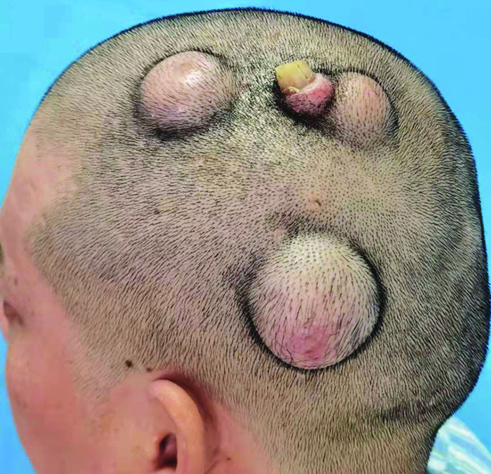 Multiple skin tumours on the scalp with the middle tumour showing firm, nail-like keratin mass