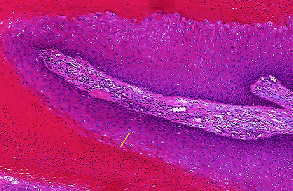 Hematoxylin and eosin stained section showing a cyst in the dermis with the cyst wall composed of squamous epithelium without granular layer. The cells near the cyst cavity are large with the cytoplasm lightly stained (yellow arrow). Red-stained and densely arranged keratin is seen in the cyst. (H&E, ×200)