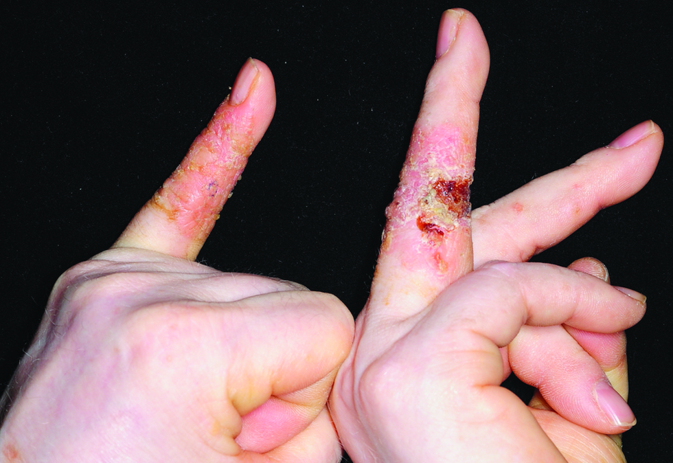Sharply demarcated red plaques on digits with a scaly and crusty surface