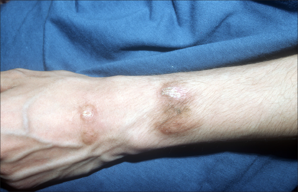 Frictional hypertrichosis: hyperkeratotic nodules on the dorsum of a hand and forearm, with hair development on their surfaces