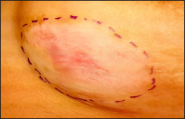 Delineated recipient site in a patient with stable segmental vitiligo