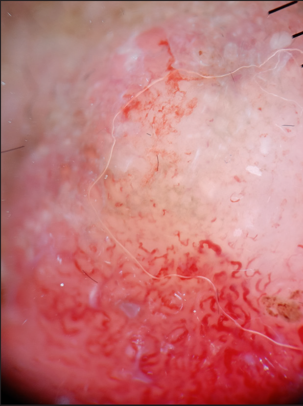 With patulous follicular openings with multiple linear serpentine vessels