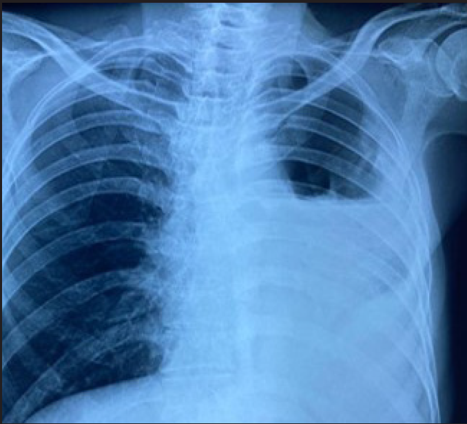 Chest radiograph showing left-sided hydropneumothorax