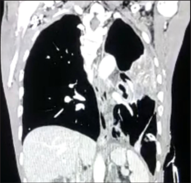 Chest radiograph showing ill-defined heterogeneously enhancing infiltrative soft tissue lesion in the left peri-hilar region