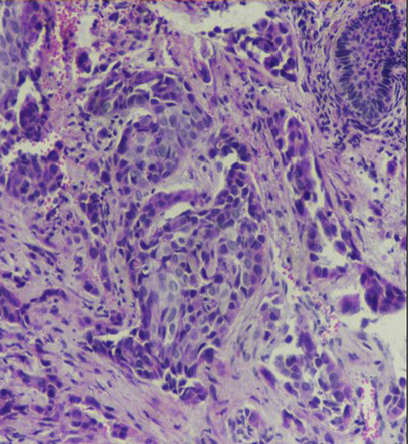 Tumour cells with focal keratinization in the dermis (H & E stain, ×100)