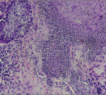 Tumour not extending into the overlying dermis (H & E stain, ×100)