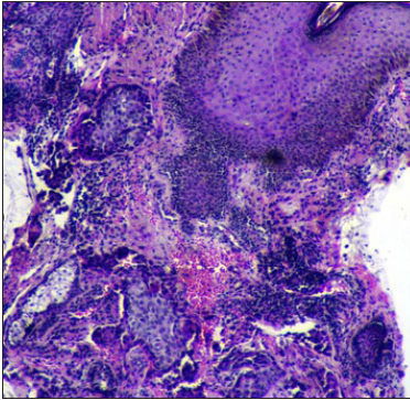 Tumour cells and islands in dermis (H & E stain, ×40)