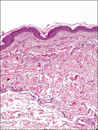 The histopathological exam revealed a proliferation of capillary vessels with turgescent endothelial cells within the dermis, scattered extravasated erythrocytes with hemosiderin (HE × 100)