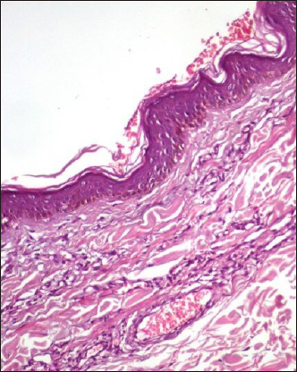 Proliferation of capillary vessels within the dermis (HE × 200)