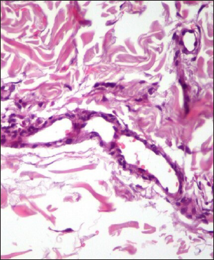 High magnification shows proliferating endothelial cells and focal small vessel formation within the dermis (HE × 400)