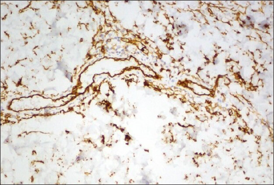 Immunohistochemistry showed expression of CD34 highlighting the endothelial nature of proliferating cells within the dermis (staining CD34 × 200)