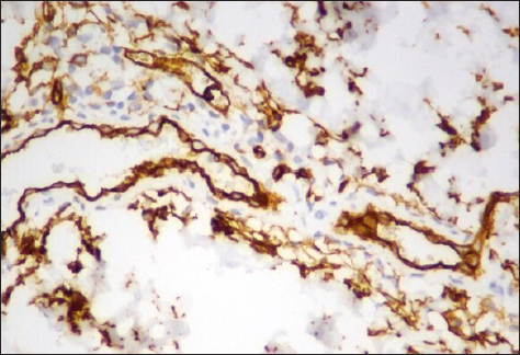 Immunohistochemistry showed expression of CD34 highlighting the endothelial nature of proliferating cells within the dermis (staining CD34 × 400)