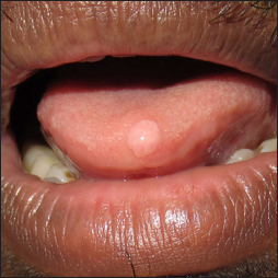 Solitary flesh-coloured, dome-shaped, smooth papule on the tip of the tongue
