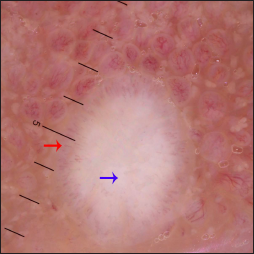 The dermoscopic examination under polarized mode (Heine Delta 20T, ×10) shows a central white homogeneous area (blue arrow) and a peripheral corona of hairpin vessels (red arrow)