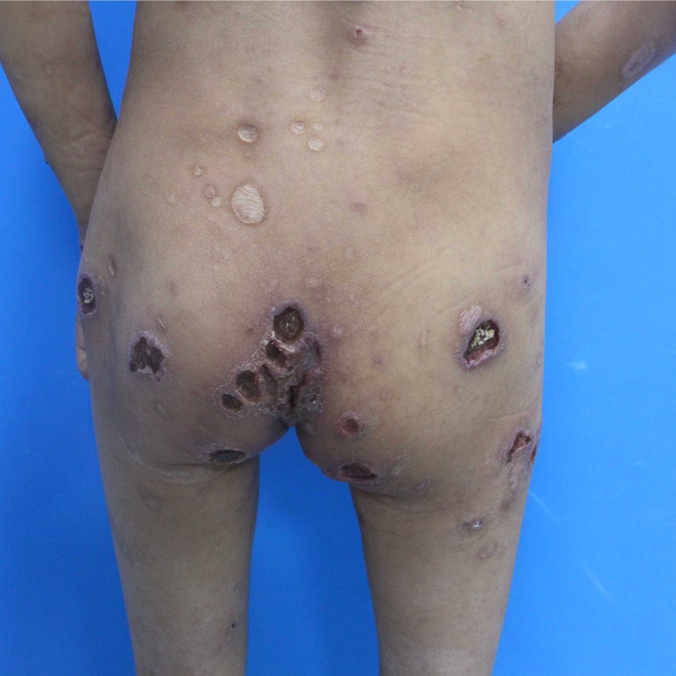 Deep ulcers, hemorrhagic crusts, hyperpigmented or hypopigmented spots and superficial atrophic scars on the trunk and extremities