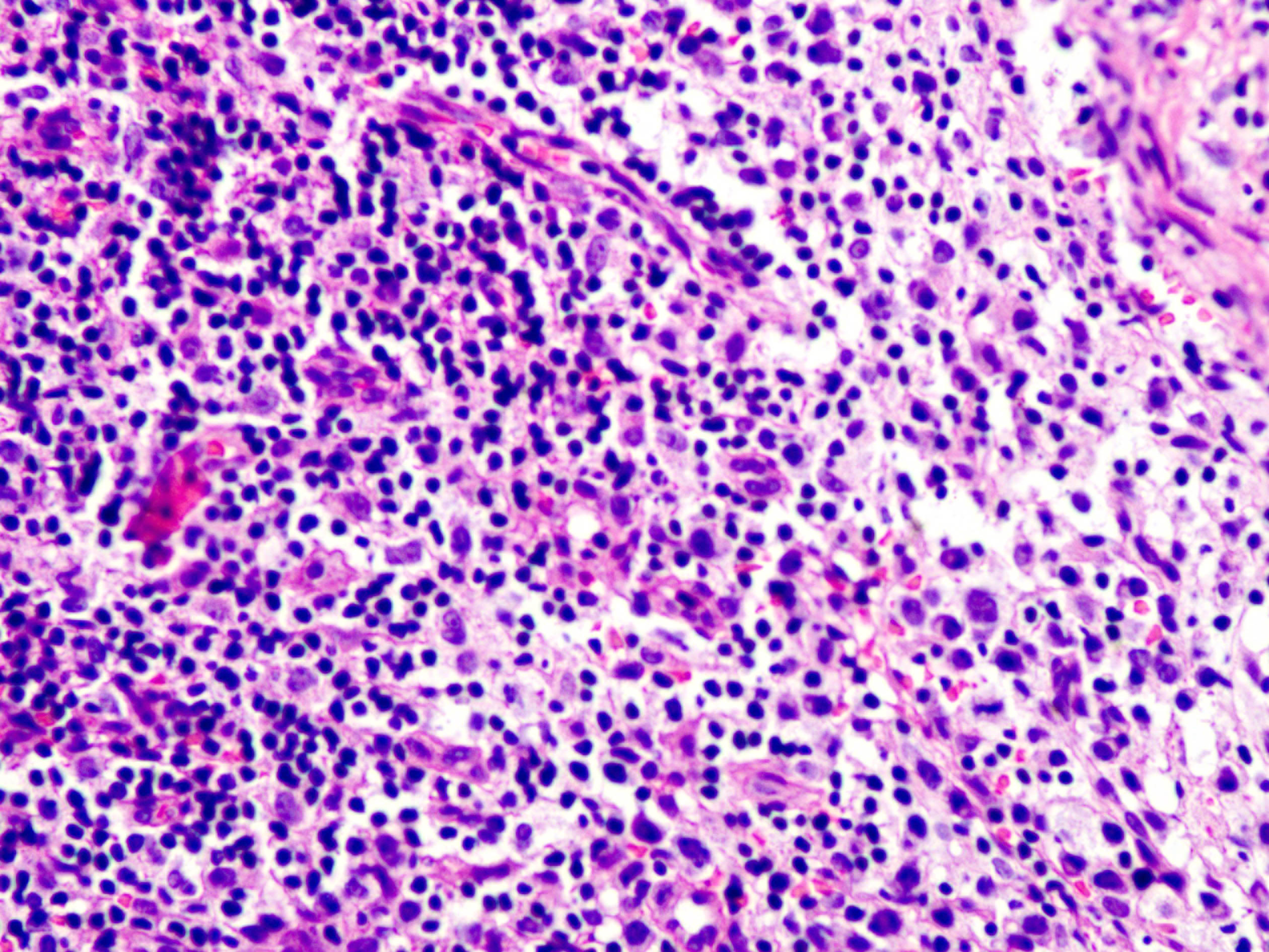 Some lymphocyte morphologies of the right inguinal lymph node are mildly atypical, invading the follicle (hematoxylin-eosin stain, magnification ×400)