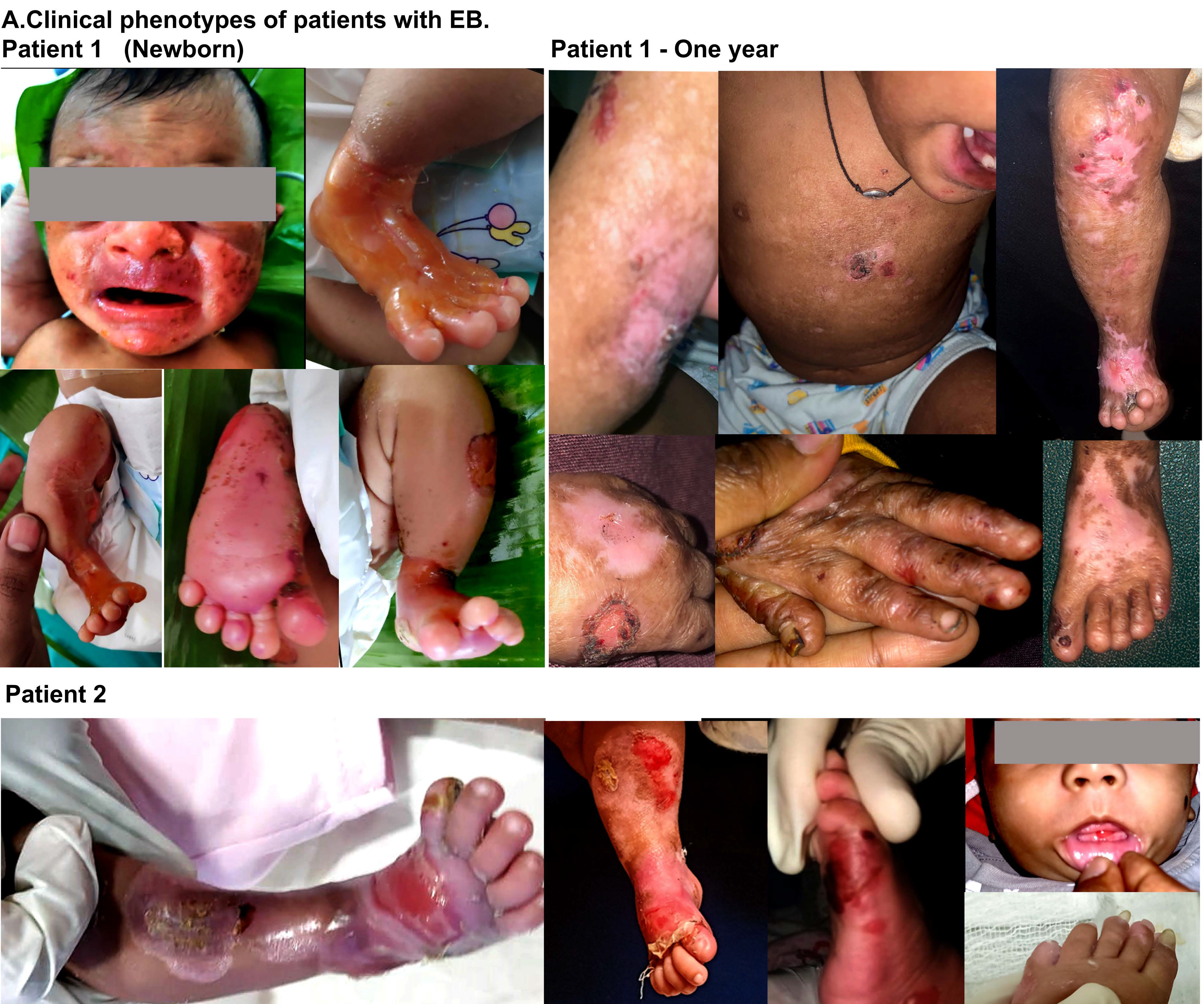 Clinical and molecular Investigations of Infants with ACC. A clinical feature showing blistering and erosion of the skin at birth (patient 1). The images of the wounds and deformity due to wound healing, scarring and fibrosis (patient 1-one year). The ACC in the new born with wound healing issues and recurrent blisters (patient 2).