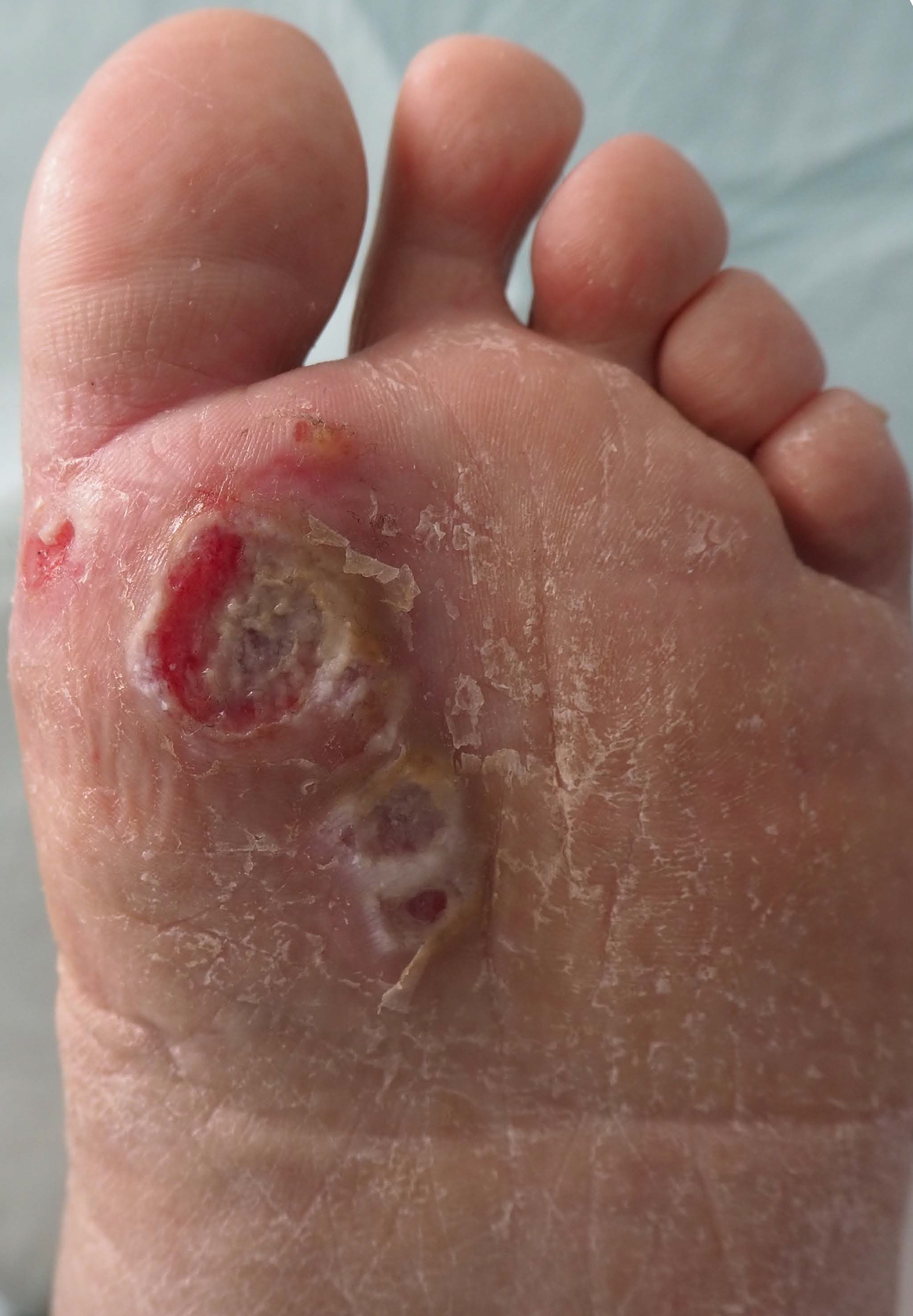 Multiple ulcers and erosions with granulating tissue on the plantar surface of a metatarsophalangeal area of the first toe