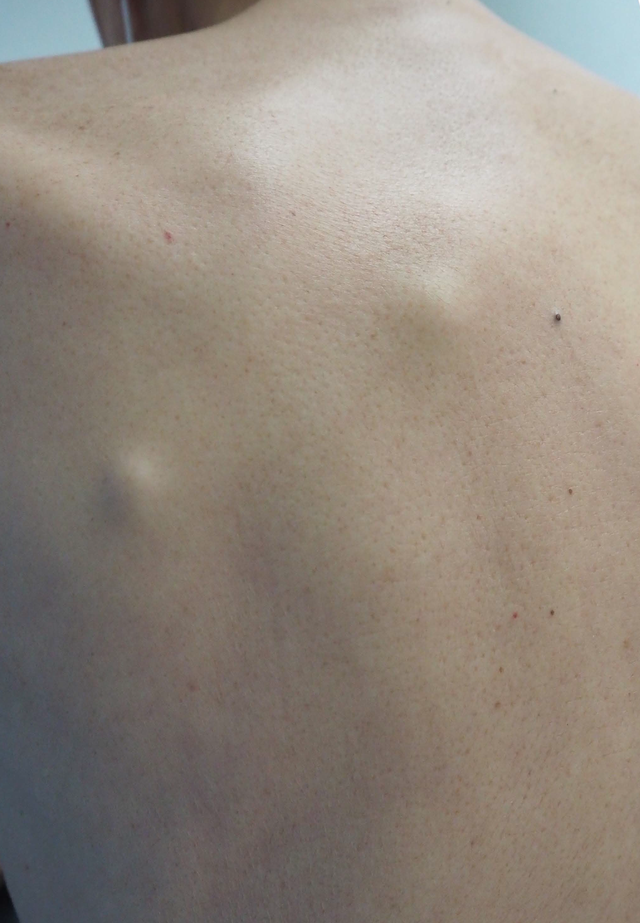 Multiple subcutaneous nodules on the back of the patient