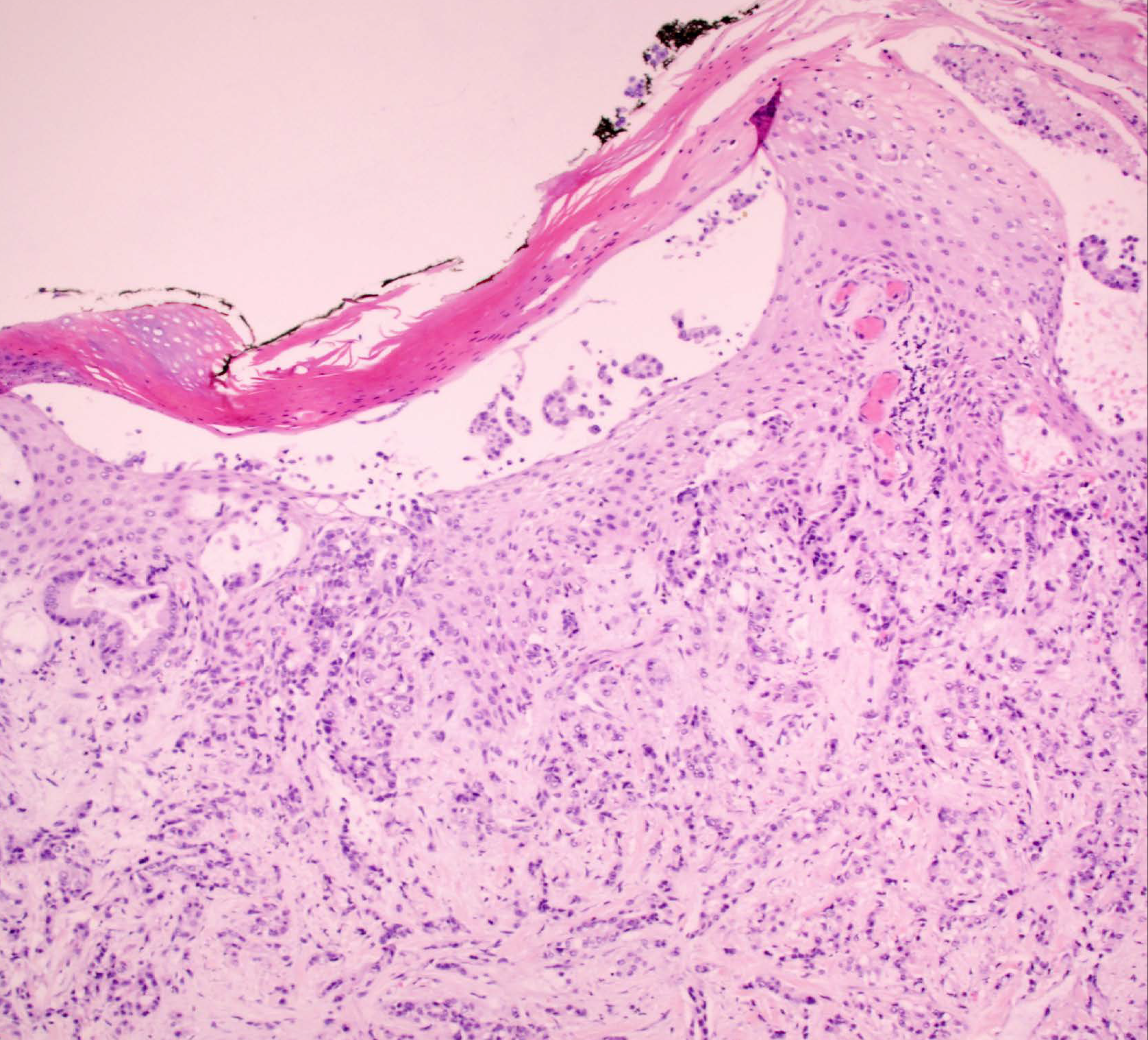 Epidermal ulceration and diffuse infiltration of the dermis by tumour cells forming glands (Hematoxyline and eosin ×10)