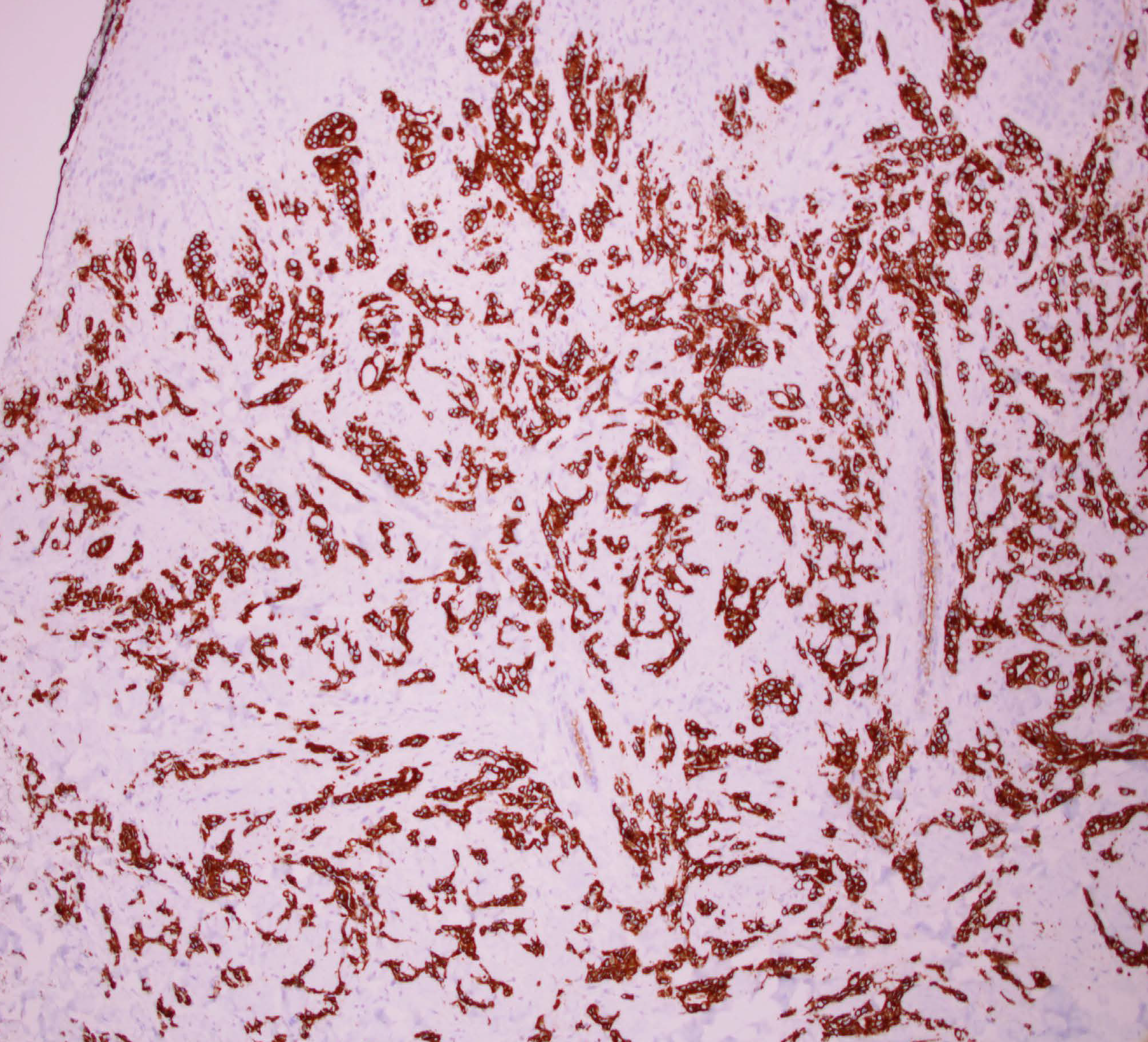 Detail of the dermal infiltration by tumour cells (Hematoxyline and eosin ×40)