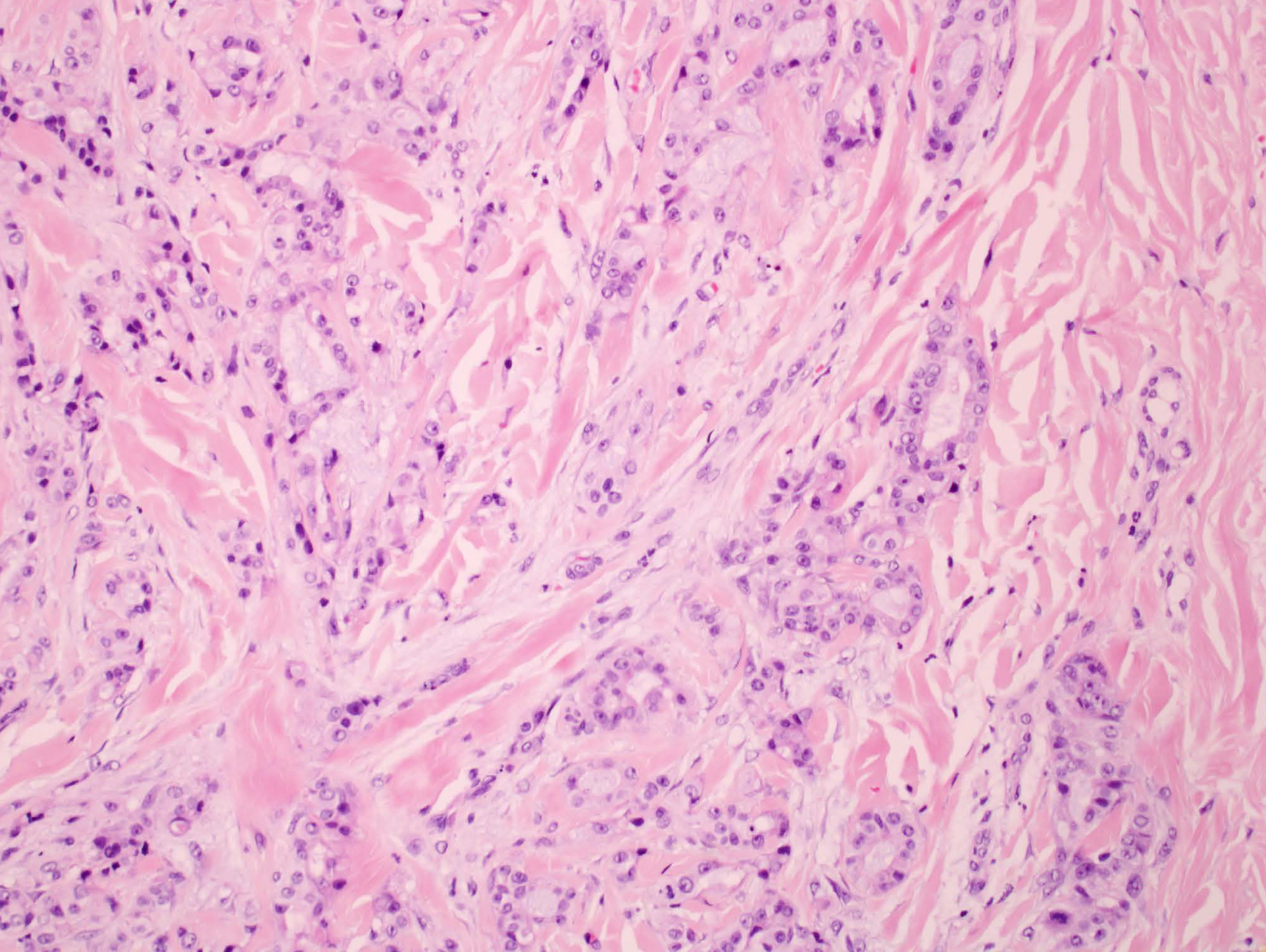 Immunohistochemistry staining results for CK7 show intensive positivity on neoplastic cells