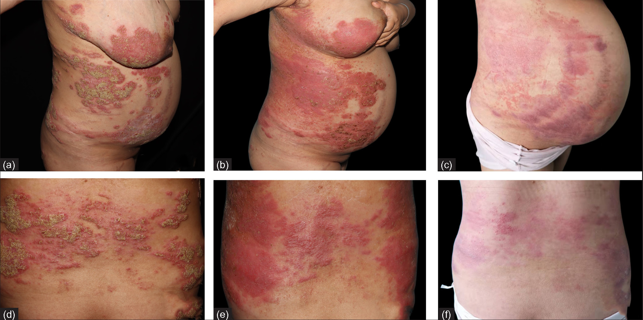 Clinical images of patient 1 at (a,d) baseline,(b,e) 3 days and (c,f) 28 days after treatment