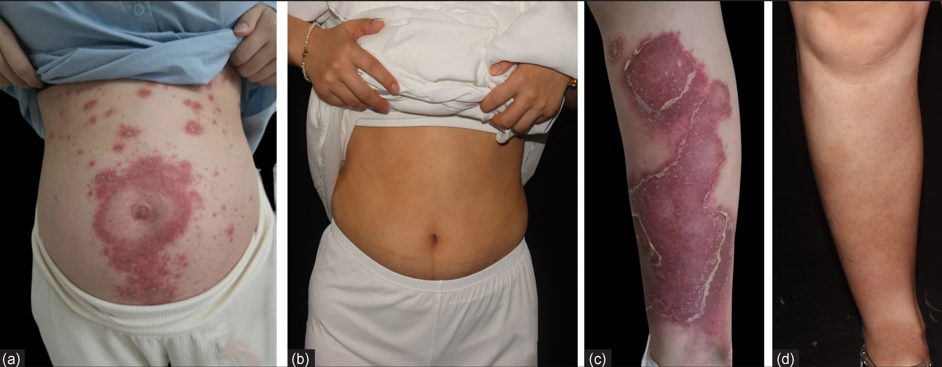 Clinical images of patient 2 at (a,c) baseline,(b,d) 1 year later after treatment