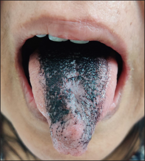 Blackish discolouration with prominent filiform papillae over the dorsum of the tongue