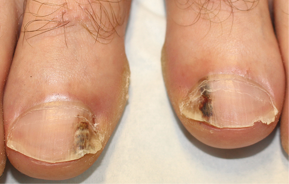 Longitudinal black bands on bilateral great toenails