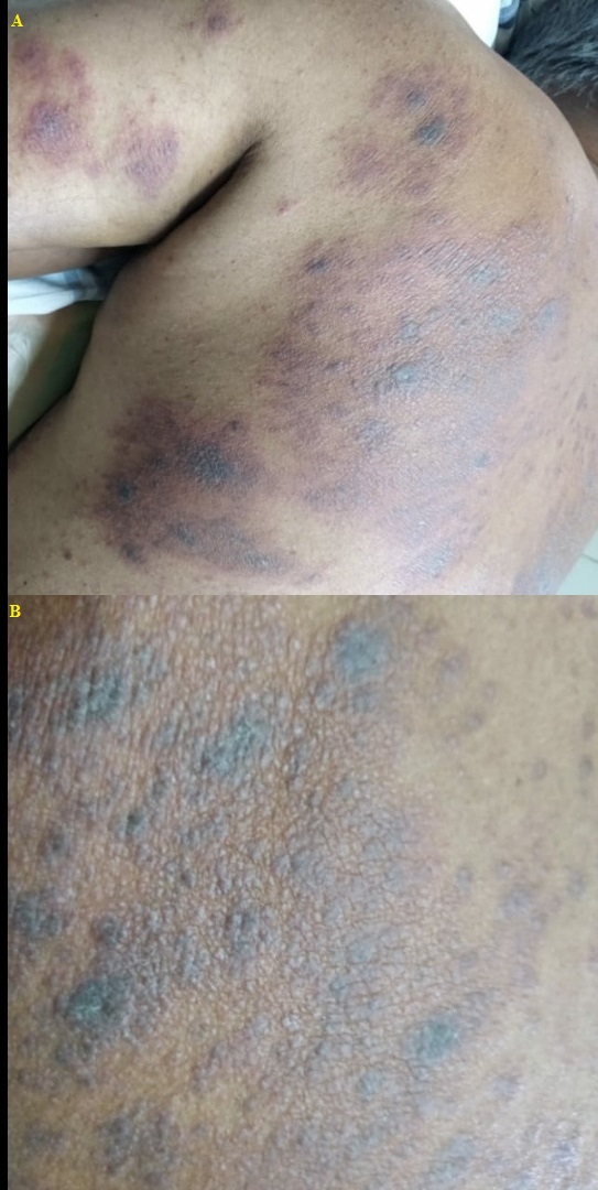 A 42-year-old male presented with history of lesions that initially appeared on the back. (A) Multiple ill-defined erythematous patches and a few violaceous plaques on upper back and left upper arm. (B) Multiple skin coloured to violaceous papules to plaques