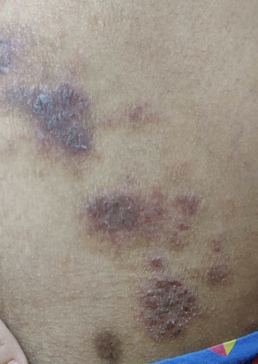 A 33-year-old female presented with lesions multiple erythematous plaques on lower back with a few lesions with crusting