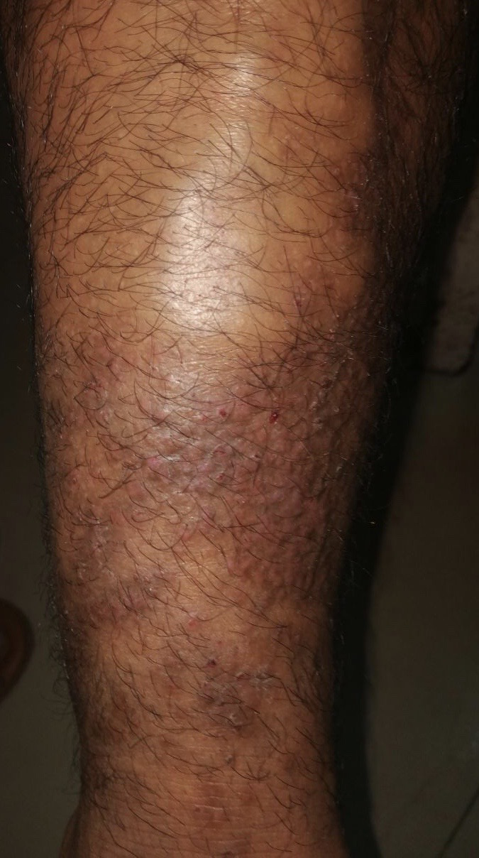 A 37-year-old male presented with multiple itchy skin-coloured to erythematous, discrete to coalescent papules with erosions on shin