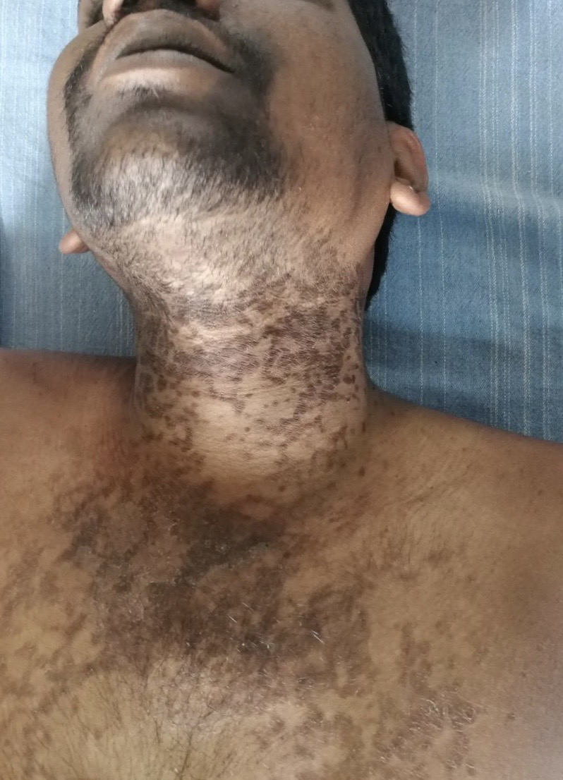 A 29-year-old male presented with multiple hyper pigmented macules to on neck and upper chest