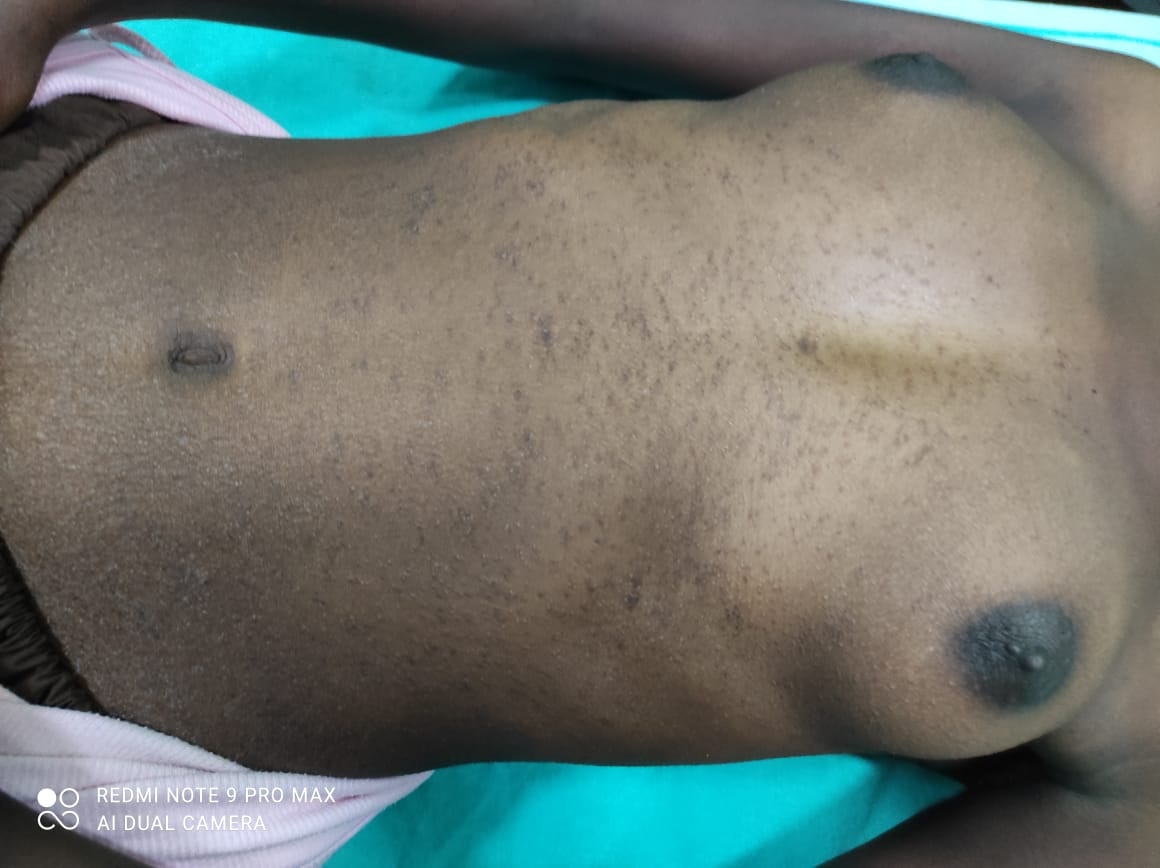 A 17-year-old female presented with multiple tiny grouped, skin-coloured to reddish-brown papules, on the abdomen, chest, back and proximal parts of the limbs